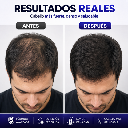 SADOER® Shampoo + Acondicionador Minoxidil 5% + Biotina Anticaida